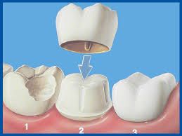 Miford Dentists Dental Crown Example