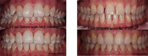 Fast Braces Orthodontics Milford Dentists