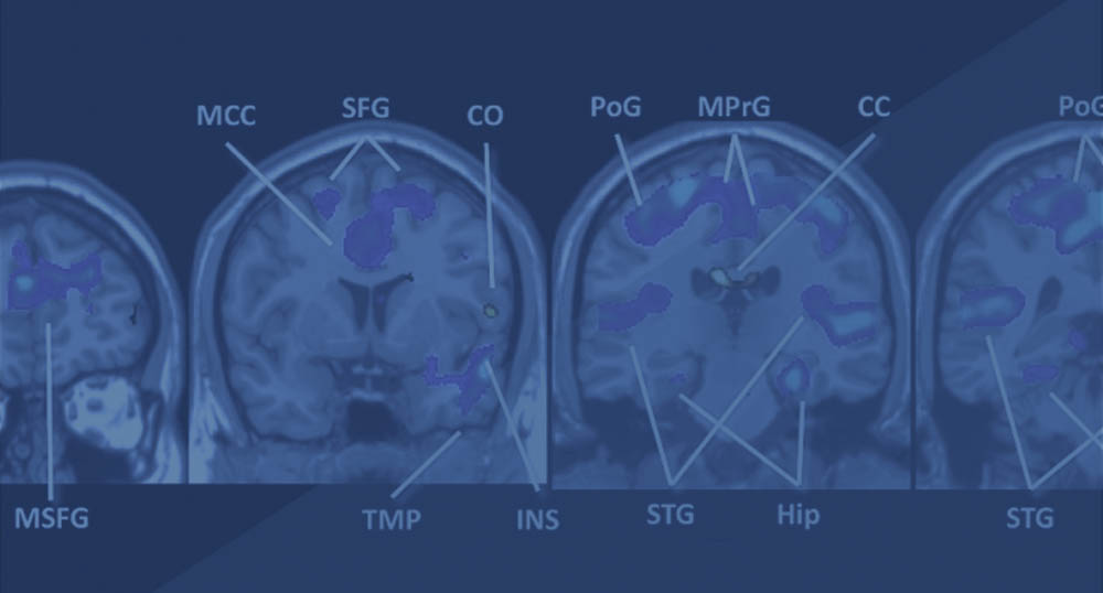 tVNS Deactivates  Tinnitus Related Brain Regions