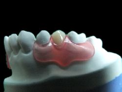 Milford Dentist Valplast Denture