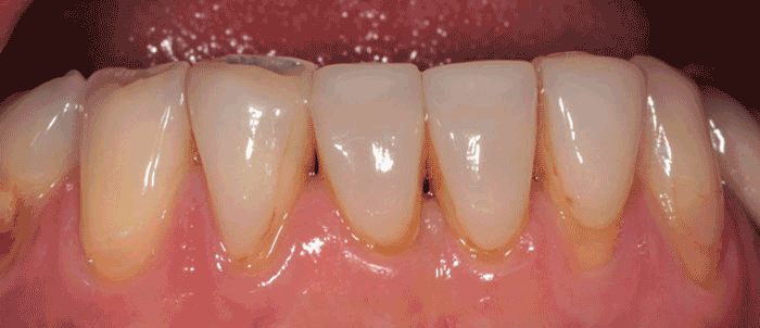 Milford Dentists Tooth Veneers