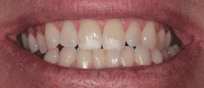 Milford Dentist Teeth Whitening