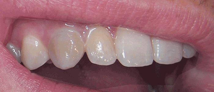 Milford Dentist Tooth Whitening Image