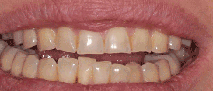 Milford Dentists Tooth Veneers