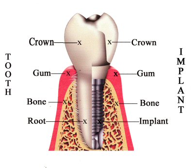 Milford Dentists Dental Implant