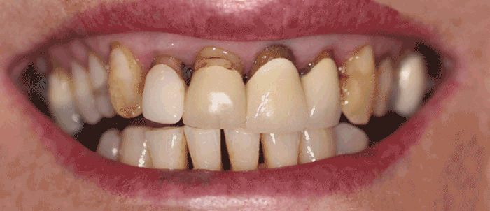 Milford Dentist Dental Crowns Before & After