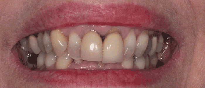 Milford Dentists Dental Crowns