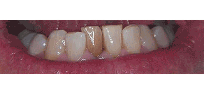 Milford Dentist Before and After Root Fillilng