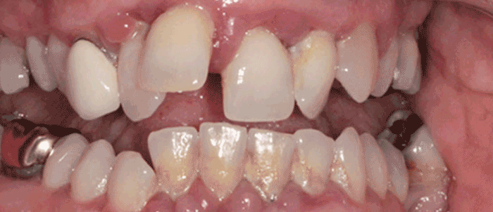 Dental Bridge before and after