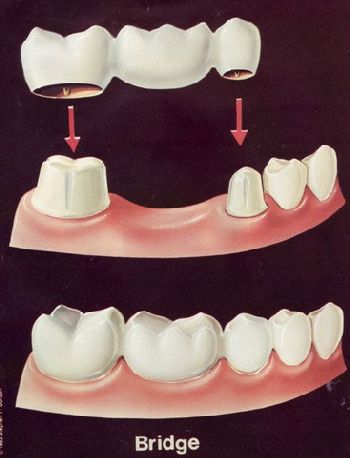 Fixed porcelain bridge Milford Dentists