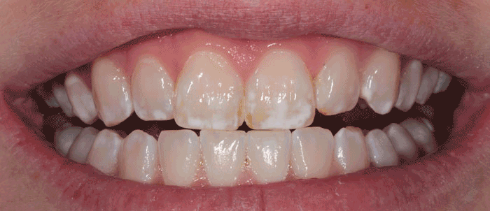 Milford Dentists Tooth Whitening