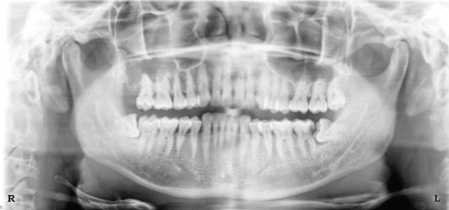 Milford Dentist Wisdom Teeth Removal